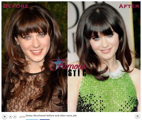 zooey deschanel filler|Zooey Deschanel Plastic Surgery: Has the Actress Had Work Done